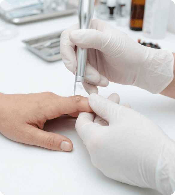 Dermatological procedure removing a benign skin growth A bright, close-up photograph of a targeted dermatological tool being used by a practitioner to treat or remove a small, localized skin lesion on a patient's skin surface