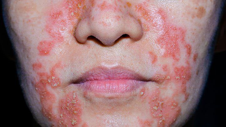 Dermatite périorale sévère avec rougeur et desquamation autour de la bouche et du nez