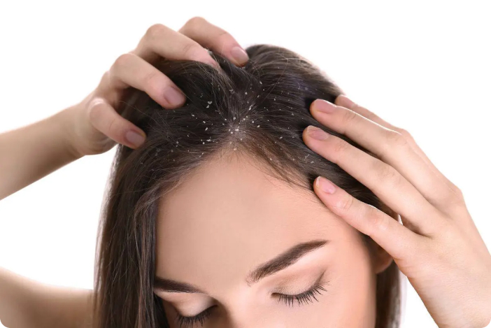 Seborrhoeic dermatitis: greasy yellowish scaling and redness on the eyebrows and around the nose